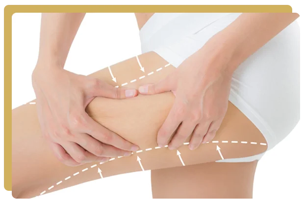 Liposuccion cuisses paris