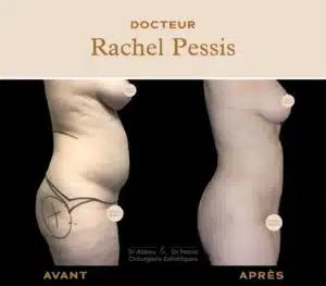 resultat lipoaspiration ventre femme