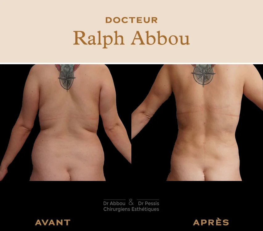 Liposuccion du dos à Paris. Dr ABBOU et PESSIS