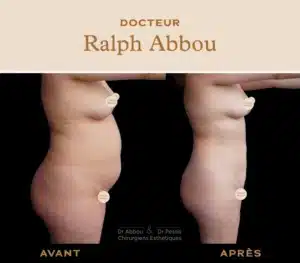resultat lipoaspiration ventre ou lipo vaser femme