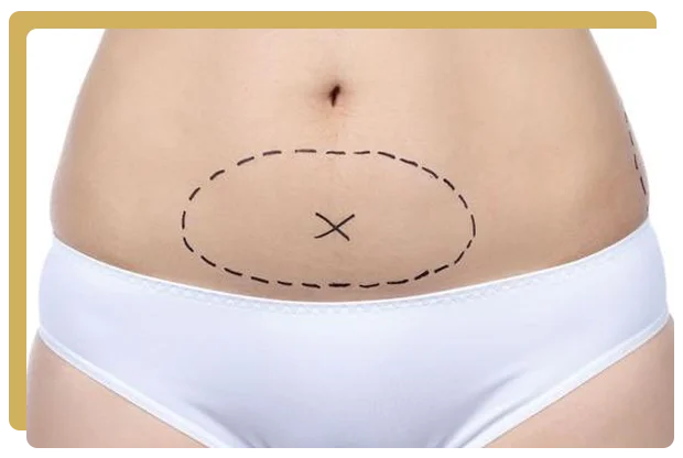 Mini abdominoplastie paris