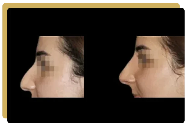 Rhinoplastie médicale paris