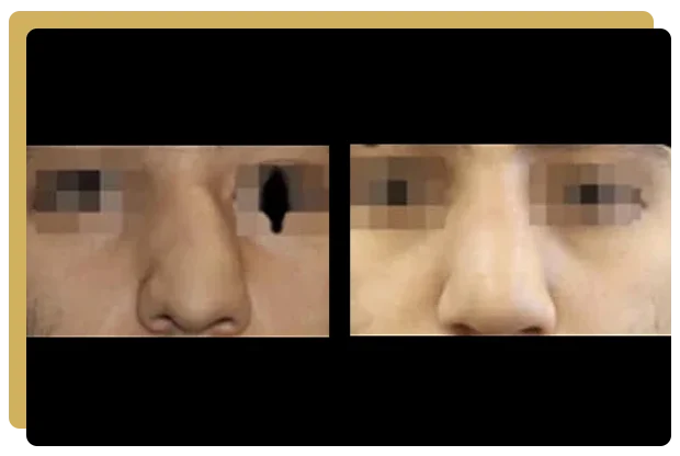 rhinoplastie apres trauma