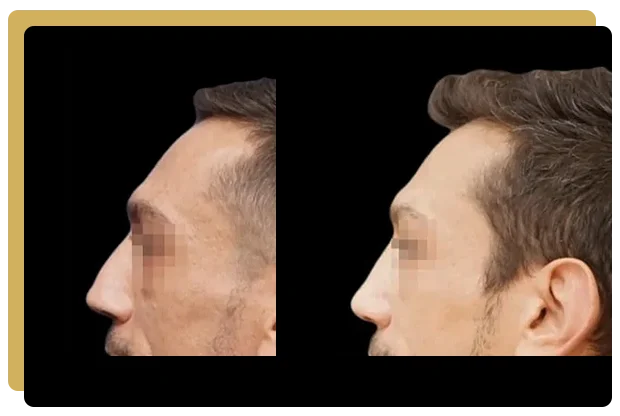 Rhinoplastie secondaire