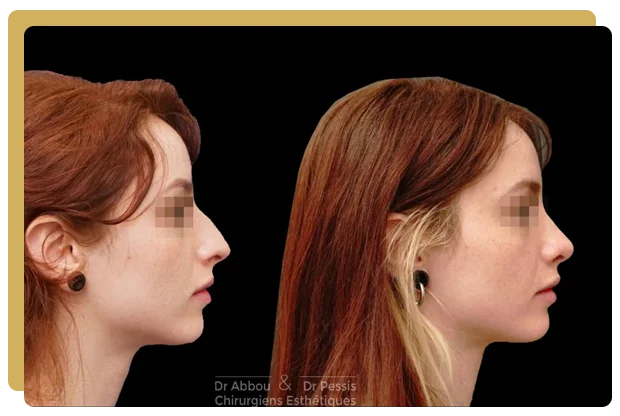 rhinoplastie resultat