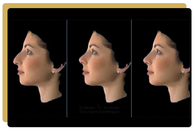 Simulation de rhinoplastie (morphing) : anticiper l'opération