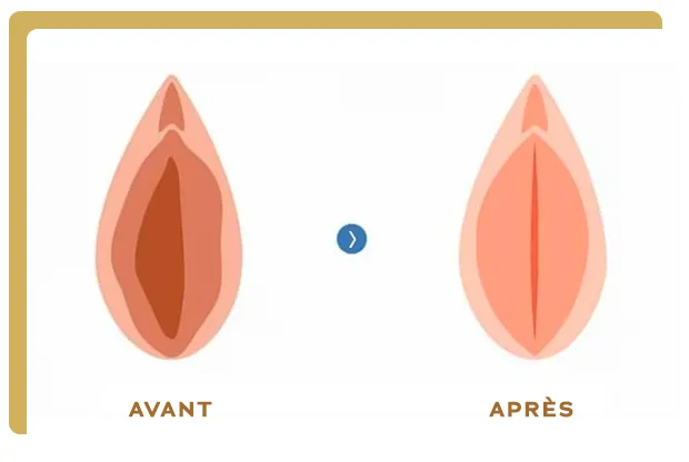 Vaginoplastie paris