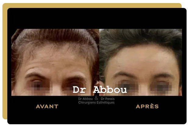 lifting frontal paris