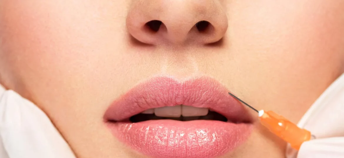 Injection acide hyaluronique levres