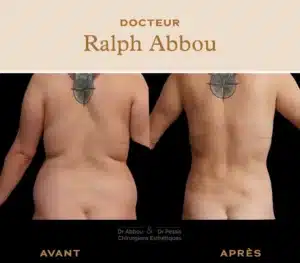 liposuccion poignée d'amour resultat