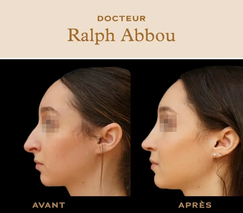 Rhinoplastie ultrasonique Paris- Dr Ralph ABBOU