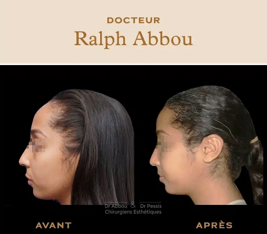 Implantation Cheveux Turquie