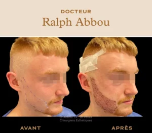 greffe de barbe