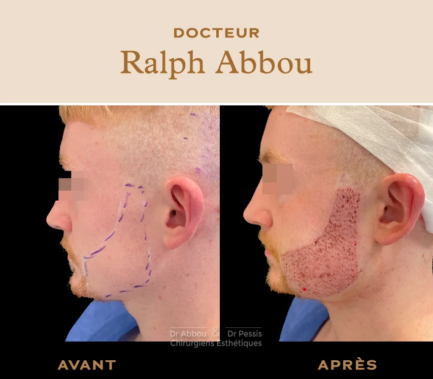 Greffe de barbe Paris - Dr Ralph Abbou - Chirurgien esthétique