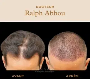 Greffe de cheveux à paris