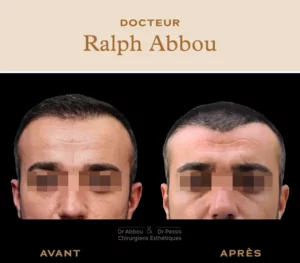 Abaissement de la ligne frontale Paris chirurgie esthétique