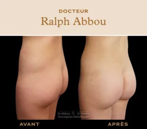 Hyacorp : augmentation des fesses