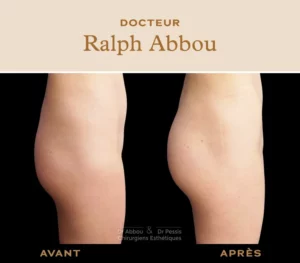 Hyacorp : augmentation des fesses