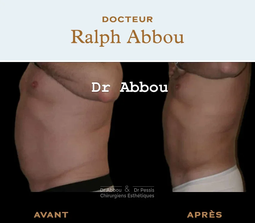 Abdominoplasty or tummy tuck : abdominal surgery in Paris