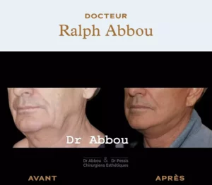 Facelift for men Paris