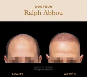 perte de cheveux paris