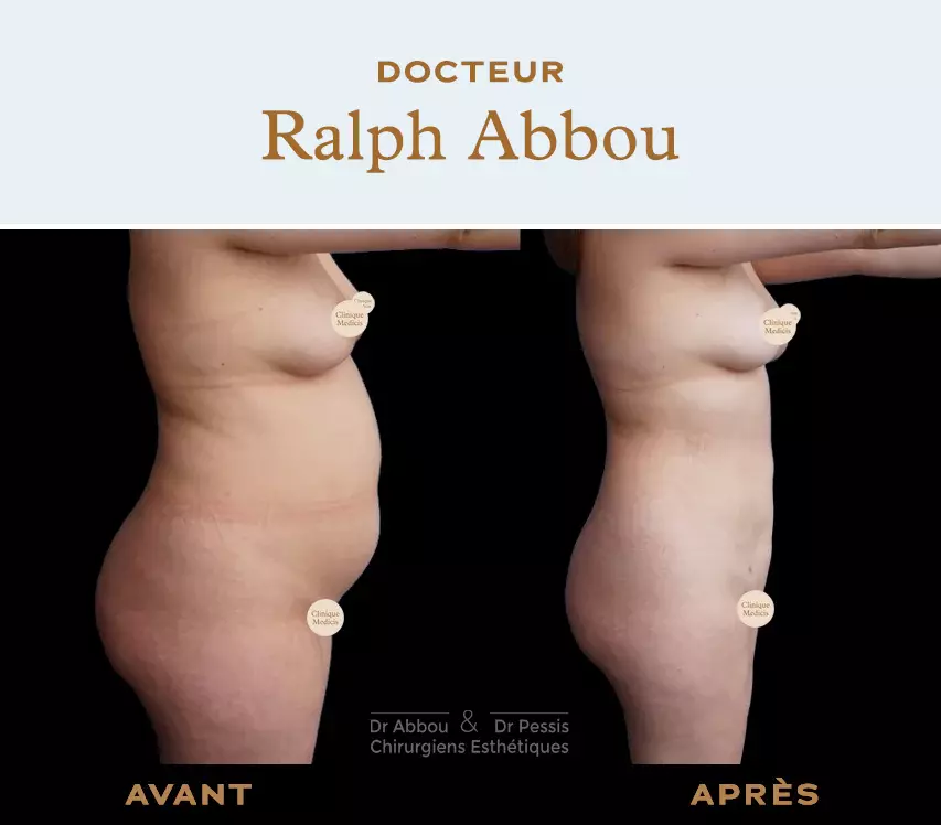 Belly liposuction in Paris. Dr ABBOU and Dr PESS