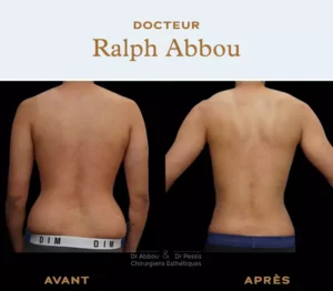 Liposuction Paris