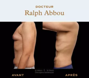 Liposuction Paris