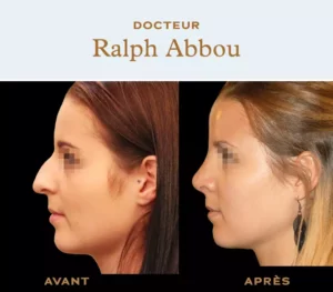 rhinoplasty