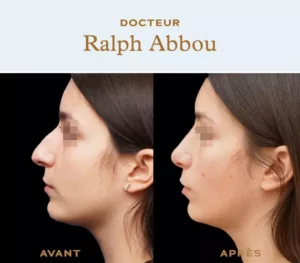 Ultrasonic rhinoplasty