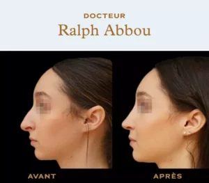 Ultrasonic rhinoplasty