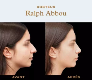 Ultrasonic rhinoplasty