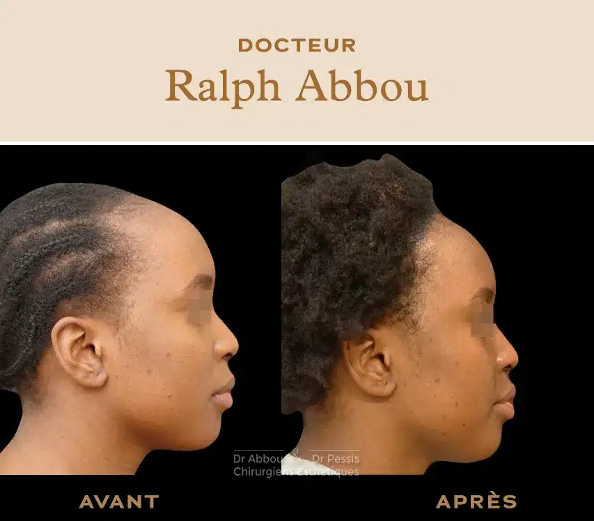 Reduction du front. Abaissement ligne frontale Paris- Dr Abbou