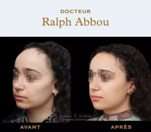 hairline lowering paris