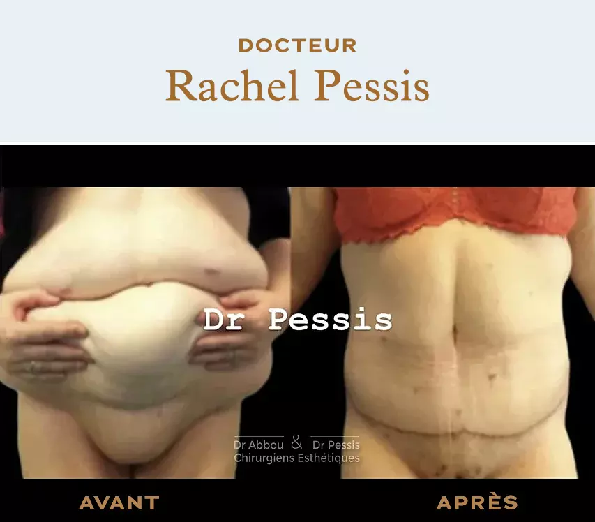 Abdominoplasty or tummy tuck : abdominal surgery in Paris