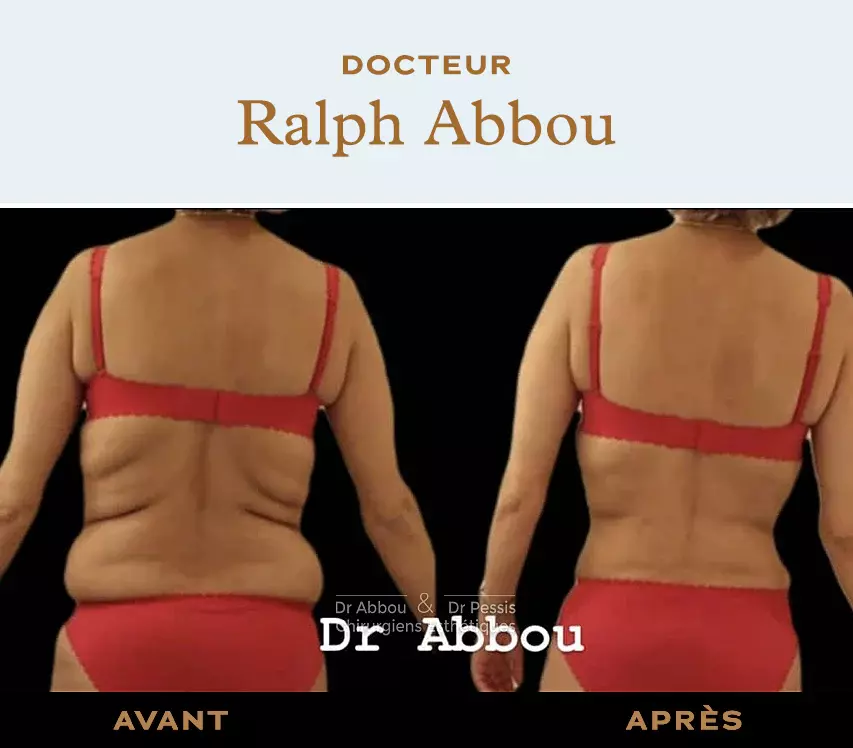 Liposuction of back rolls in Paris. Dr ABBOU and Dr PESSIS