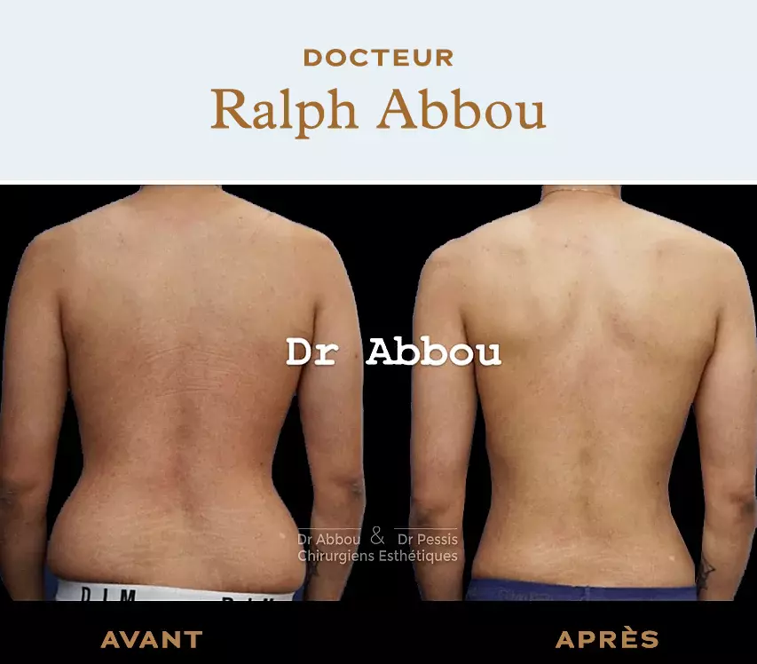 Back Liposuction: Back Fat Removal