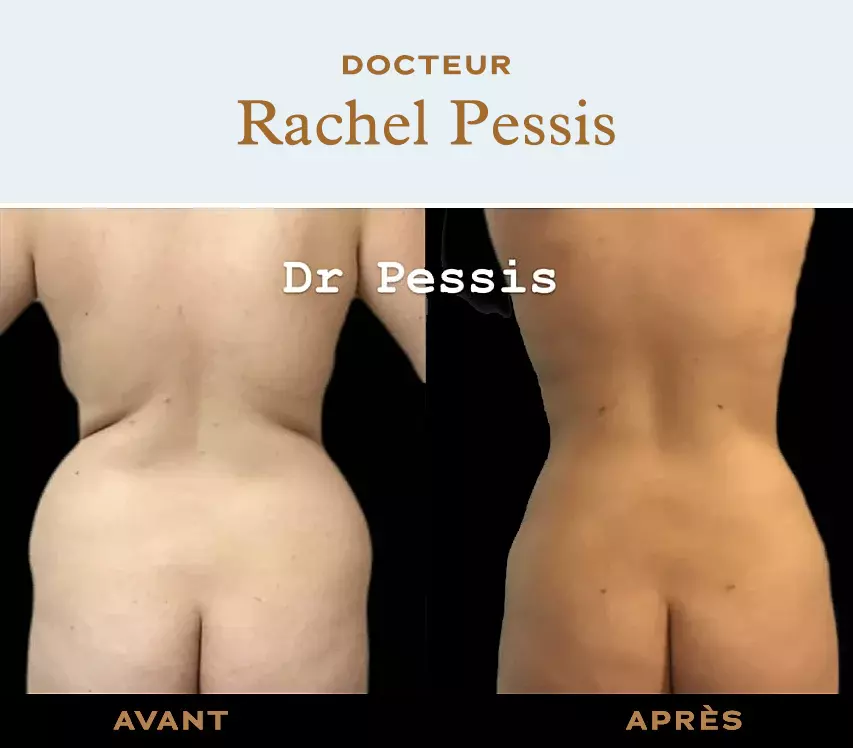 Liposuction of back rolls in Paris. Dr ABBOU and Dr PESSIS