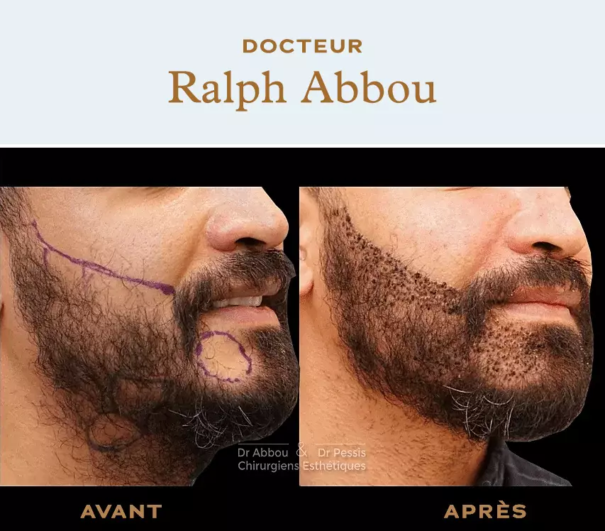 Facial Hair Transplant  Partha Skin  Hair