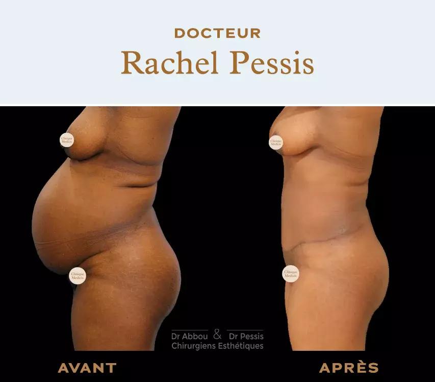 Belly surgery : operations and prices in Paris - Dr Abbou