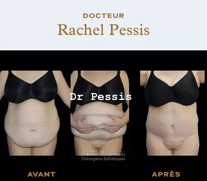 Abdominoplasty or tummy tuck : abdominal surgery in Paris