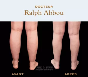 Calves liposuction Paris