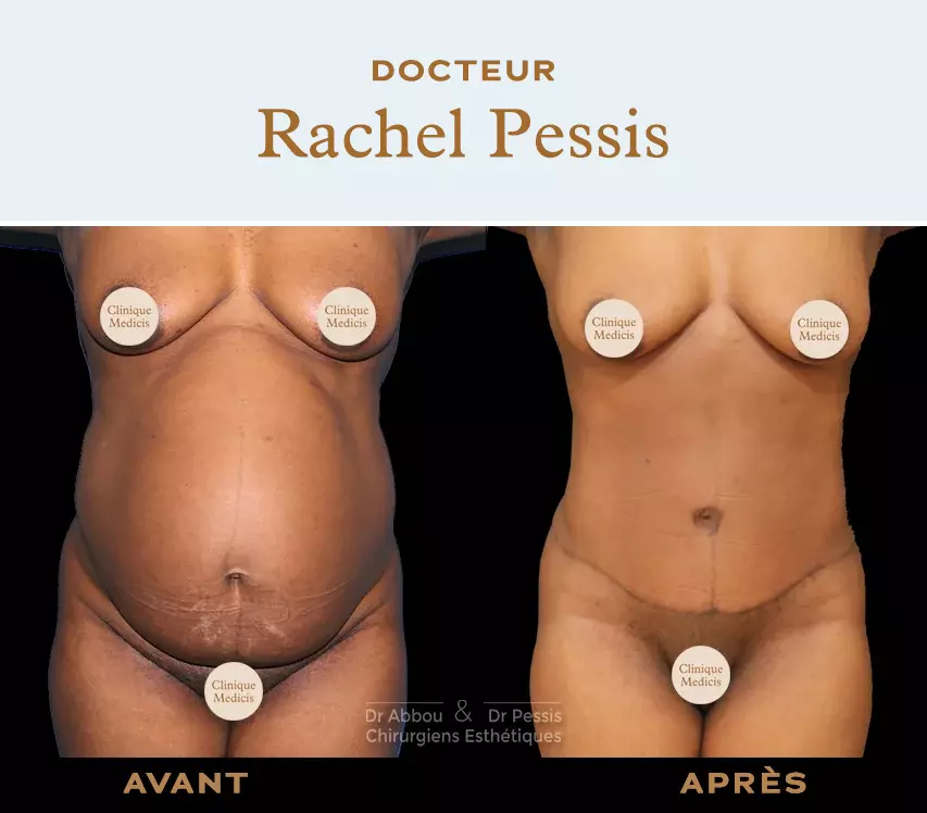 Diastasis recti repair Paris. Dr ABBOU and Dr PESSIS