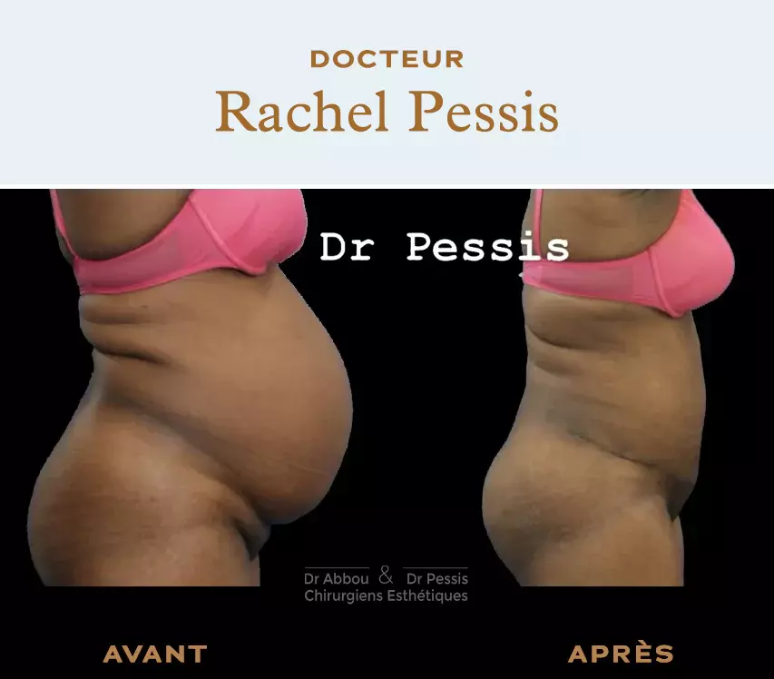 Diastasis Recti Surgery, Procedure Overview