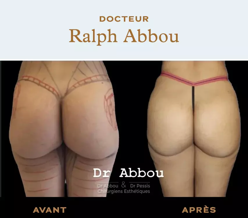 Buttock Augmentation Chico CA