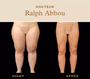 Liposuccion des cuisses