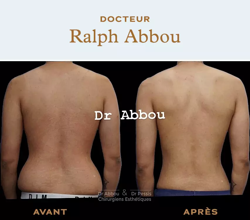 Liposuction of love handles in Paris. Dr ABBOU and Dr PESSIS