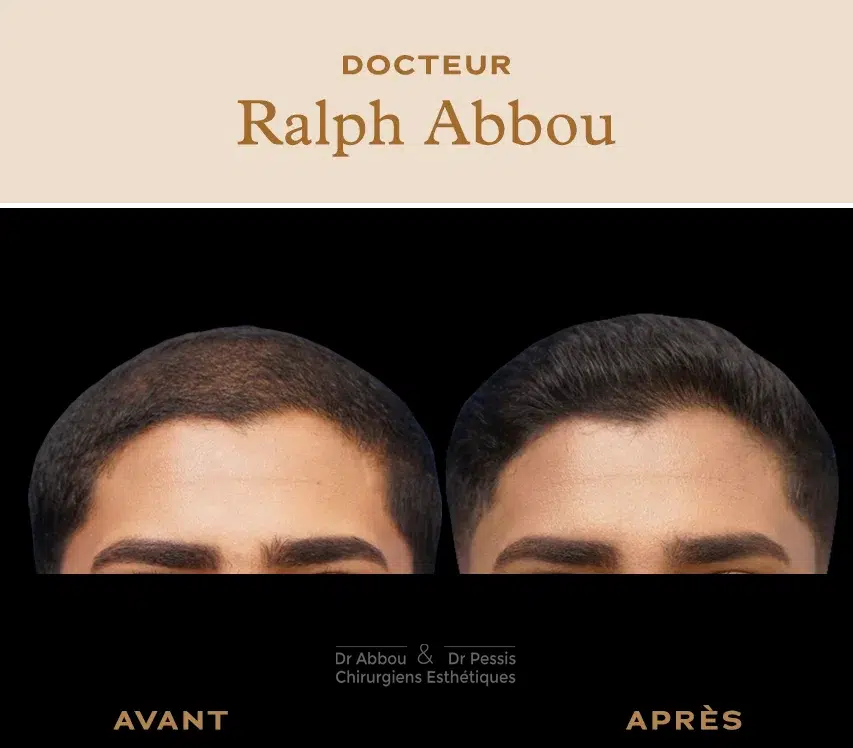 Mesotherapie cheveux Paris. Dr ABBOU et Dr PESSIS