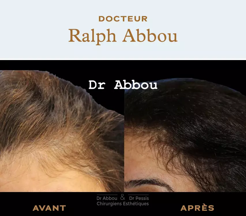 PRP. injections of platelet-rich plasma Paris PRP. injections of platelet-rich plasma Paris