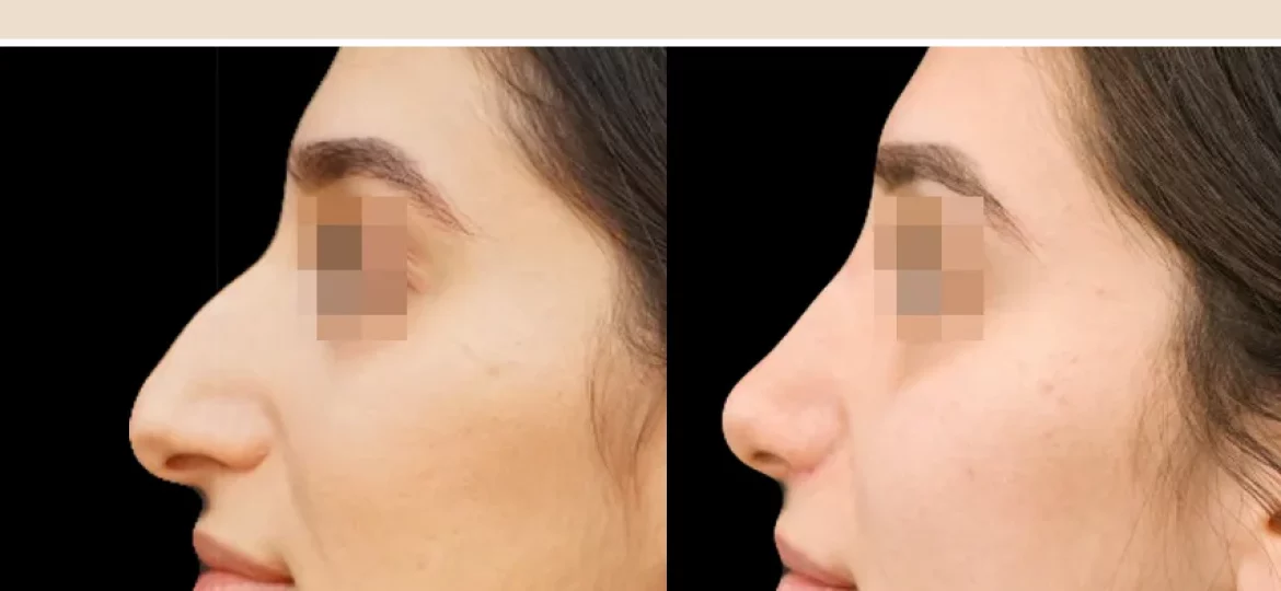 Rhinoplastie ultrasonique